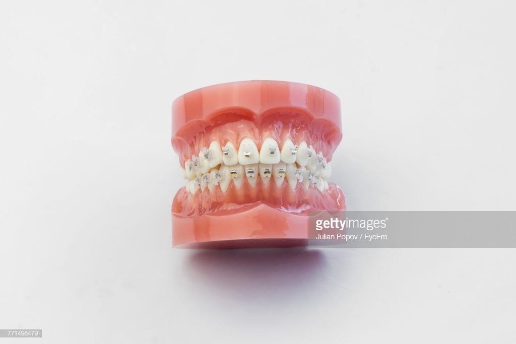 Upper Dentures Without Palate Kingston WI 53939